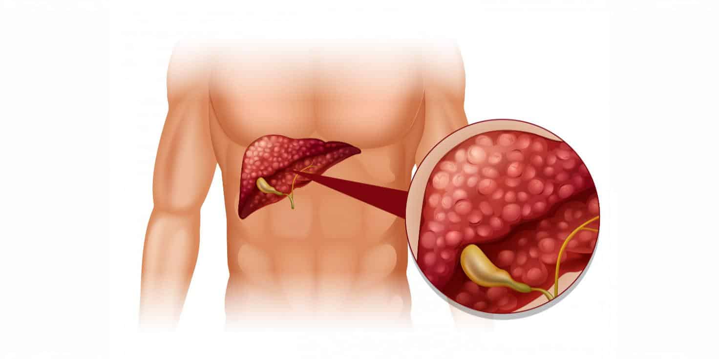 Fatty Liver Disease: A Silent Epidemic Gripping India